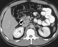 Pancreatic tumour on CT scan (arrow) width=